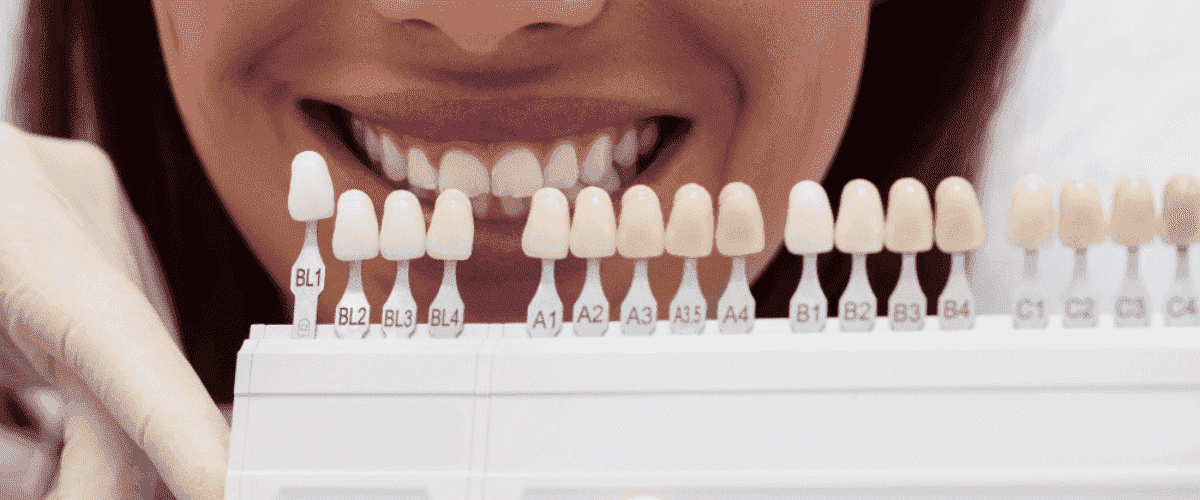 composite veneers