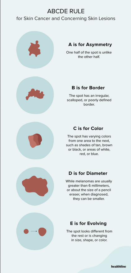 ABCDE Rule for Skin Cancer Self-Checking