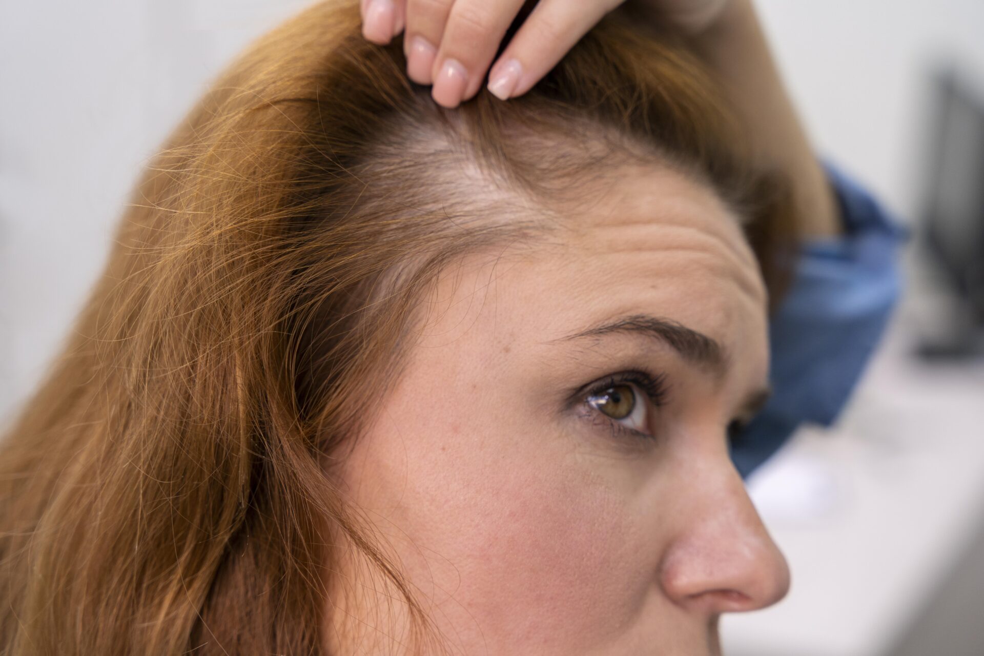 Photo of Hair and Apperance Changes due to Chemotherapy Side Effect