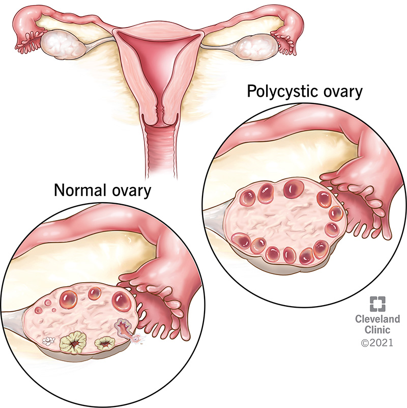 Polycystic Ovary Syndrome PCOS